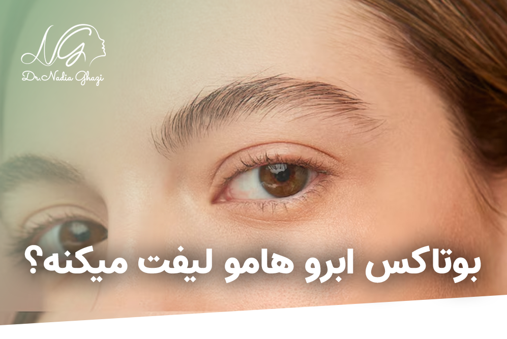 آیا میتواند با بوتاکس ابرو را لیفت کرد؟