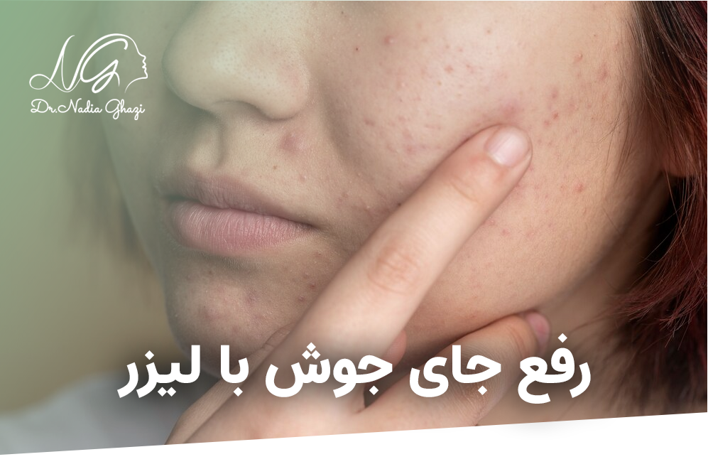 ایا جای جوش با لیزر برطرف میشود؟